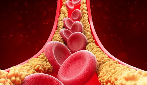 Cholesterol cao - 'thủ phạm' âm thầm bào mòn động mạch vành
