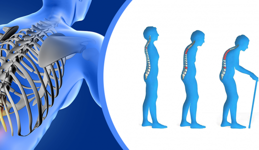 Loãng xương: Thủ phạm âm thầm gây tàn phế ở người cao tuổi