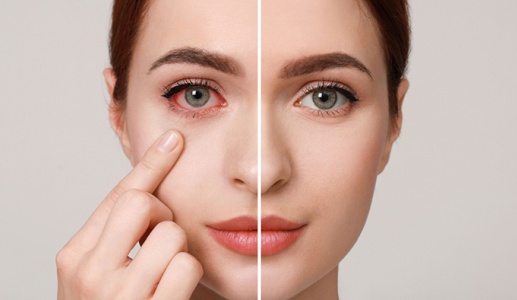 Sai lầm cần tránh khi bị đau mắt đỏ