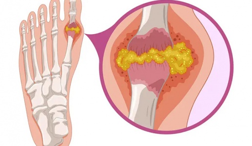 Nguy cơ từ các hạt tophi do bệnh gout  