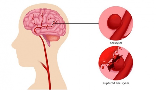 Dấu hiệu tiềm ẩn cảnh báo bệnh phình động mạch não