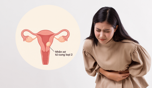 Cách kiểm soát nhân xơ tử cung loại 2 để tránh biến chứng
