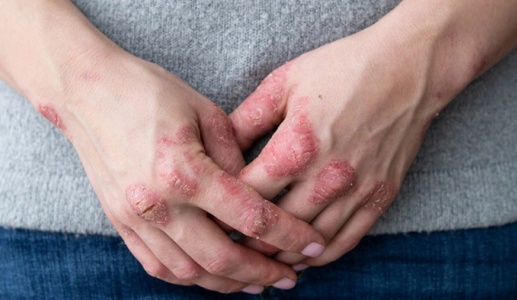 Giải pháp cho người vảy nến đang điều trị bệnh dạ dày