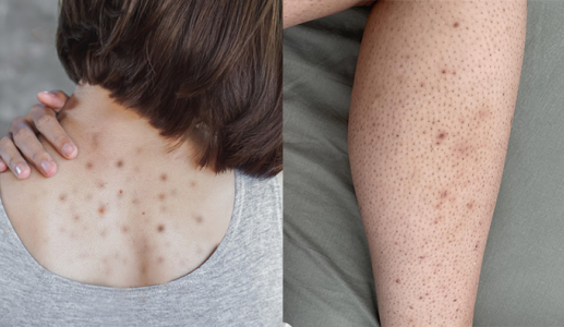 Giải pháp giúp làn da cơ thể mịn màng, hết mụn