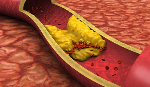 5 cách cải thiện mỡ máu cao hiệu quả