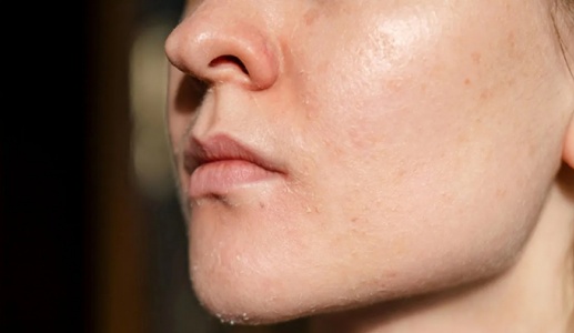 Cần làm gì khi da mặt bị bong tróc vào trời lạnh?