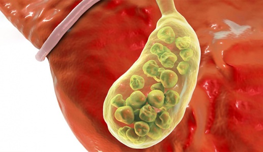 Có đám sỏi mật 27mm phải làm sao?