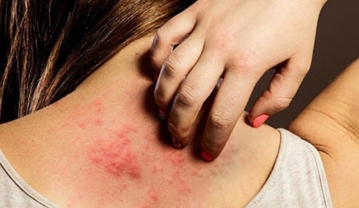 Vì sao bệnh vảy nến trở nặng khi trời lạnh?