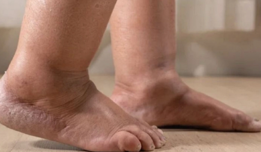 Sưng tấy bàn chân kéo dài cảnh báo dấu hiệu bệnh lý gì?