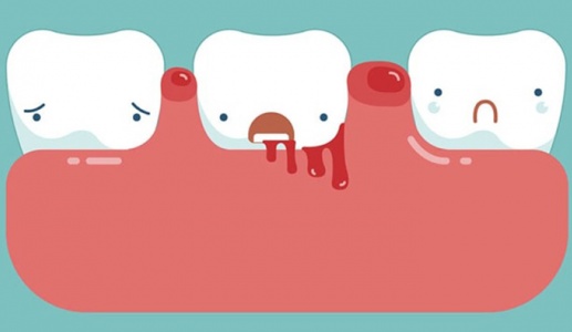 Cách cải thiện tình trạng chảy máu chân răng