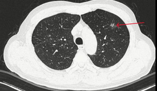 Đi khám sỏi thận, phát hiện ung thư phổi giai đoạn sớm nhờ AI