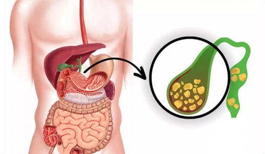 Sỏi túi mật 7,5mm có nguy hiểm không?