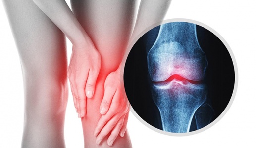 Đau xương khớp cảnh báo bệnh gì?