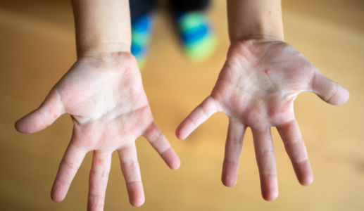 Cha mẹ cần cảnh giác với bệnh tay chân miệng ở trẻ