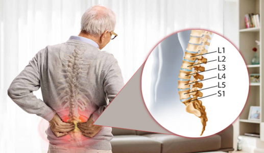 Dấu hiệu nhận biết thoái hóa đốt sống lưng L5 S1 không nên bỏ qua