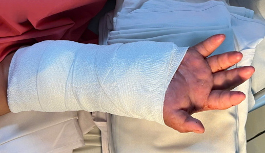 Nối lại bàn tay đứt lìa cho sản phụ, sau 2 tháng được 'ghép tạm' vào chân