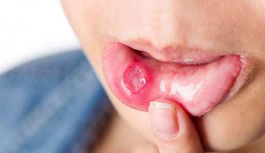 Dấu hiệu ở miệng chứng tỏ bạn thiếu vitamin B12