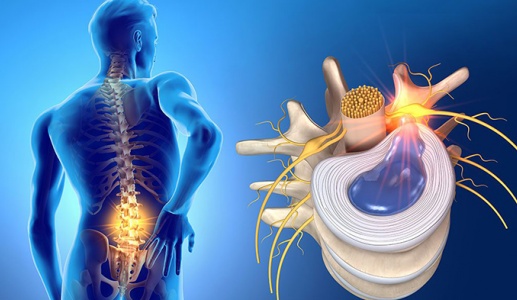 7 nguyên nhân dẫn đến thoát vị đĩa đệm