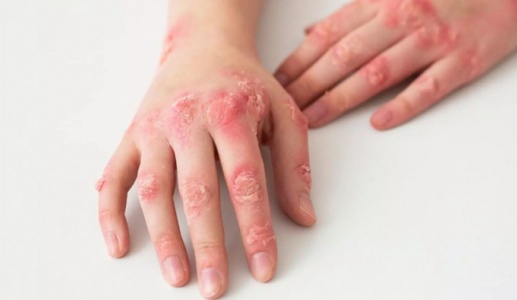 Người bệnh lupus ban đỏ nên ăn gì để kiểm soát triệu chứng tốt?