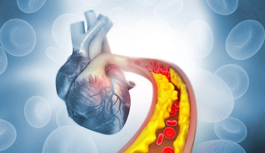 Tăng huyết áp kèm cholesterol cao: “Bộ đôi” đẩy nhanh xơ vữa mạch