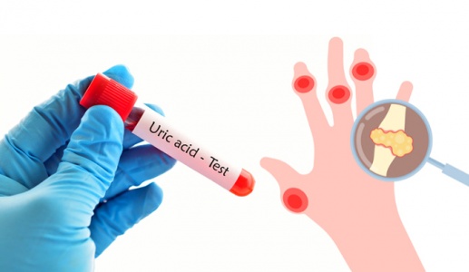 8 thói quen nhỏ giúp kiểm soát acid uric cao