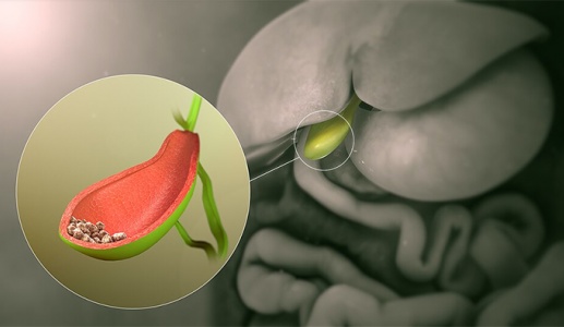 Tán sỏi qua da dễ tái phát phải làm sao?