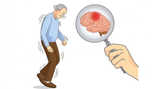 Bị run tay do thoái hóa chất trắng có dùng TPBVSK Vương Lão Kiện được không?