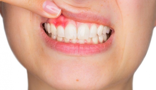 “Thủ phạm” gây viêm lợi và cách phòng ngừa thế nào?