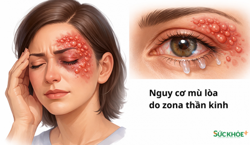 Nguy cơ mù lòa do zona thần kinh