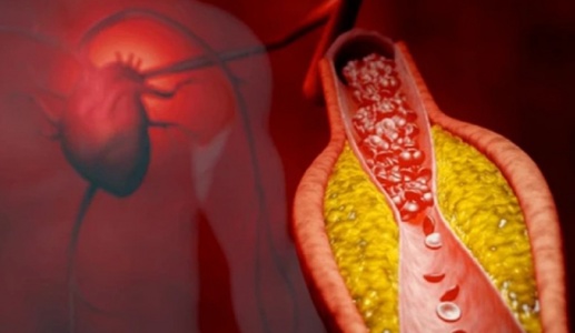 Xơ vữa động mạch - “Kẻ giết người thầm lặng” và giải pháp phòng ngừa hiệu quả