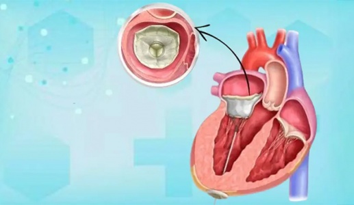 Bệnh hở van tim và tim to có chữa khỏi được không?