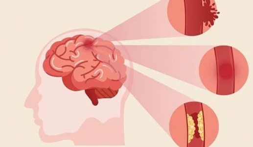 Dấu hiệu tai biến mạch máu não thường bị bỏ qua 