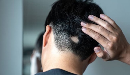 Lầm tưởng thường gặp về chứng rụng tóc từng mảng