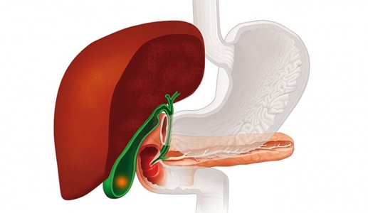 Sỏi mật 25mm dùng TPBVSK Kim Đởm Khang được không?