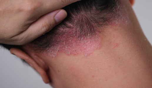 Vảy nến da đầu dễ tái phát, cải thiện ra sao?