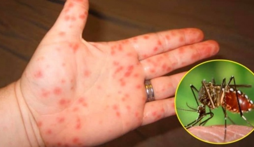 Sốt xuất huyết, tay chân miệng nặng tăng cao, Bộ Y tế cảnh báo khẩn