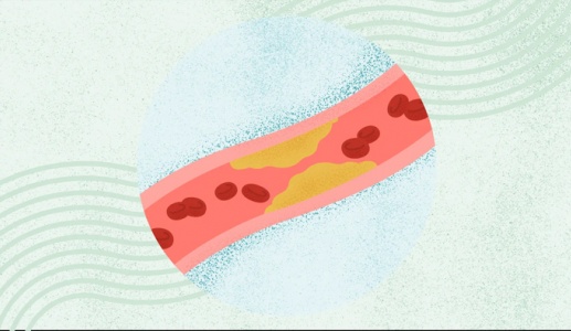 Bạn có thể mắc bệnh mạch vành dù không hề bị đau tức ngực?