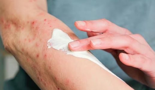 Dấu hiệu thường gặp của bệnh zona