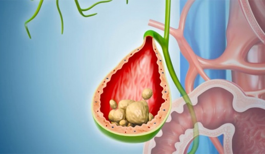 Khi nào sỏi túi mật 17mm trở thành vấn đề đáng lo ngại?