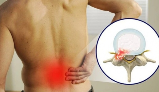 Thói quen hàng ngày khiến bệnh thoát vị đĩa đệm nặng hơn