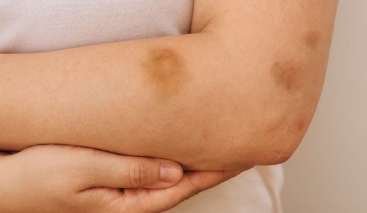 Hay bầm tím, cẩn thận thiếu vi chất