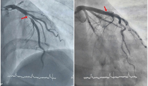 Thanh niên 29 tuổi phát hiện nhồi máu cơ tim cấp khi đi nội soi dạ dày