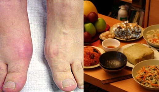 Mẹo để ngăn bệnh gout “ghé thăm” ngày Tết