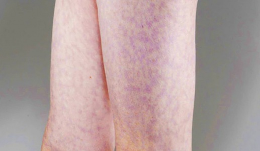 Dấu hiệu lạ trên da có thể cảnh báo vấn đề tim mạch