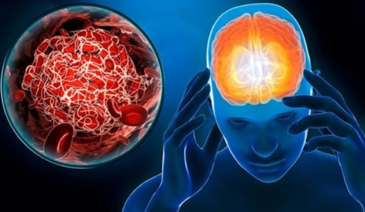 Nguyên nhân tai biến mạch máu não và cách phòng ngừa hiệu quả