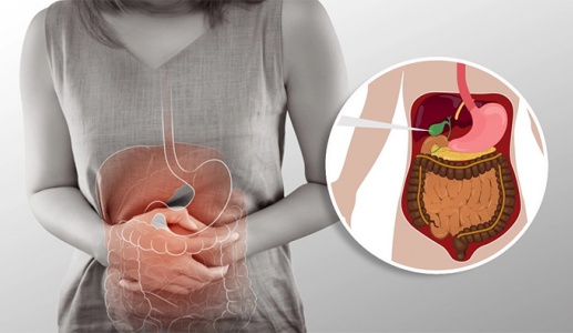 Có 3 viên sỏi mật 8mm dùng TPBVSK Kim Đởm Khang được không?