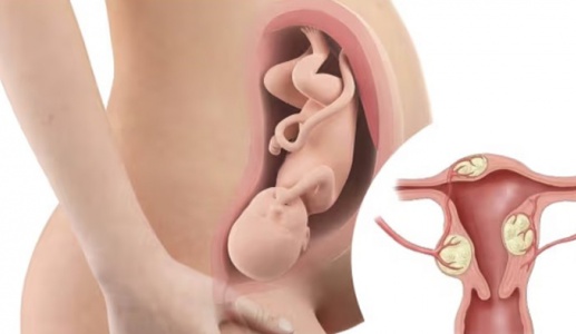 U xơ tử cung có gây khó mang thai không?