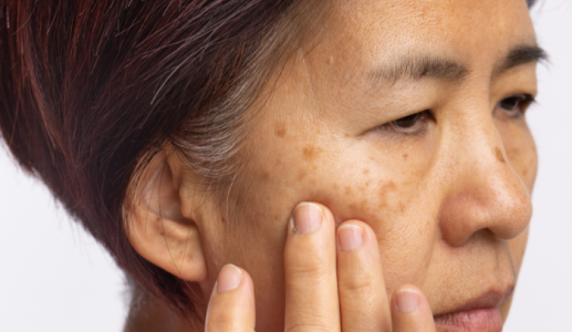 Phân biệt sạm da, tăng sắc tố và nám để bảo vệ da hiệu quả