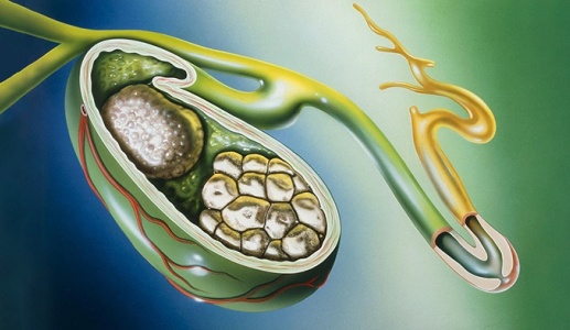 Tại sao đã mổ lấy sỏi mật 13mm vẫn tái phát sau 6 tháng?