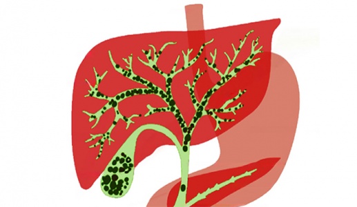 Sỏi gan 7,5mm nên mổ hay dùng cách tẩy sỏi gan 1 ngày?